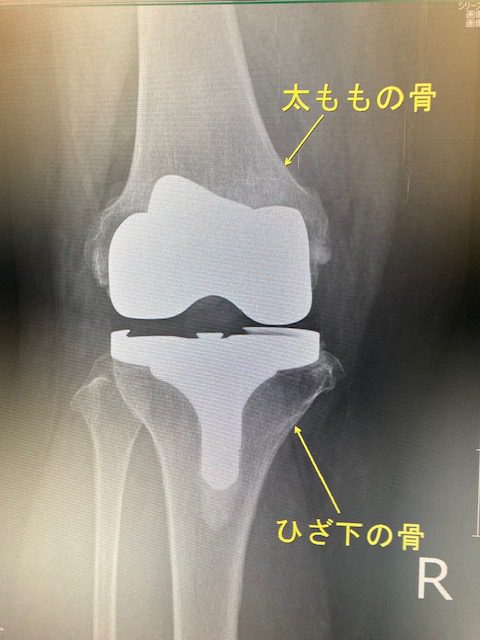 術 関節 人工 膝 置換 人工膝関節(ひざかんせつ)全置換術とは｜医療法人ここの実会 嶋崎病院